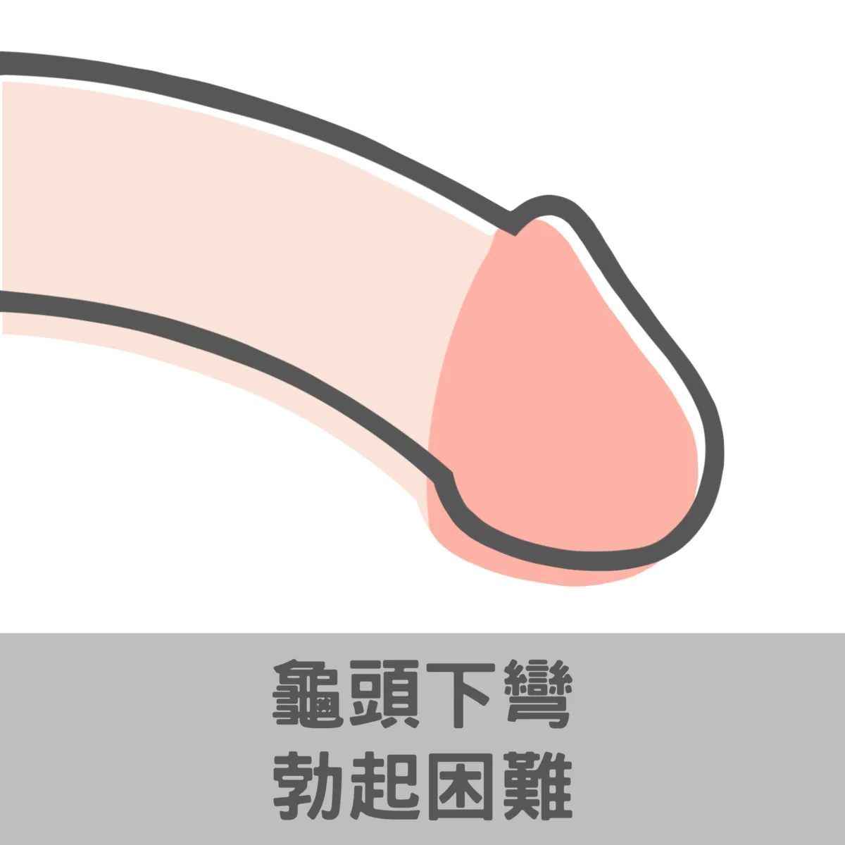 龜頭下彎勃起困難