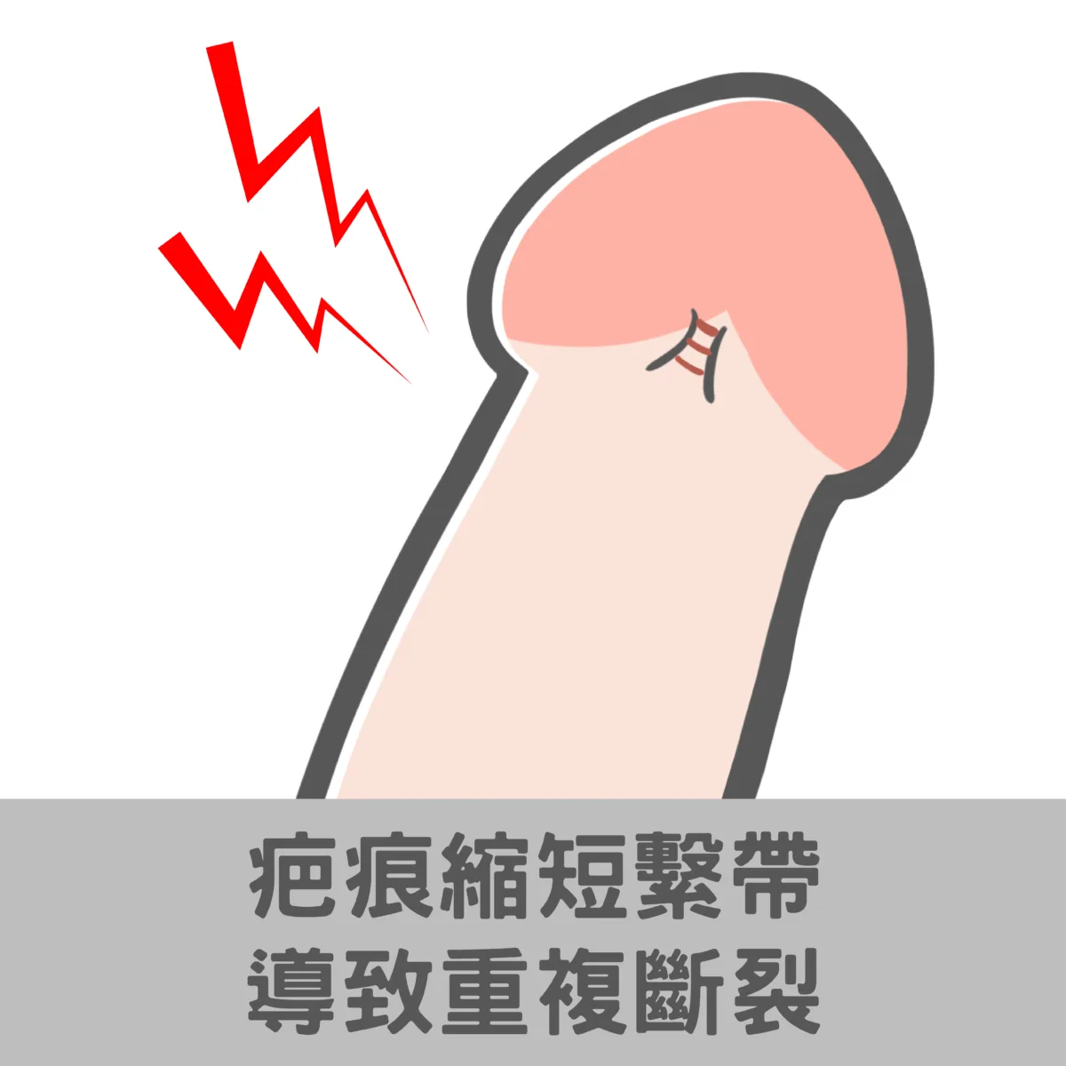 疤痕縮短繫帶導致重複斷裂