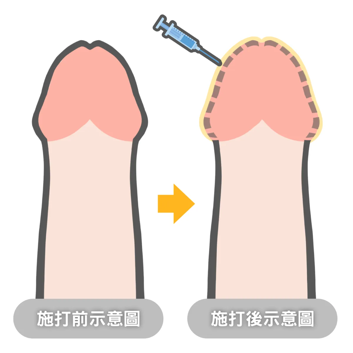 龜頭減敏