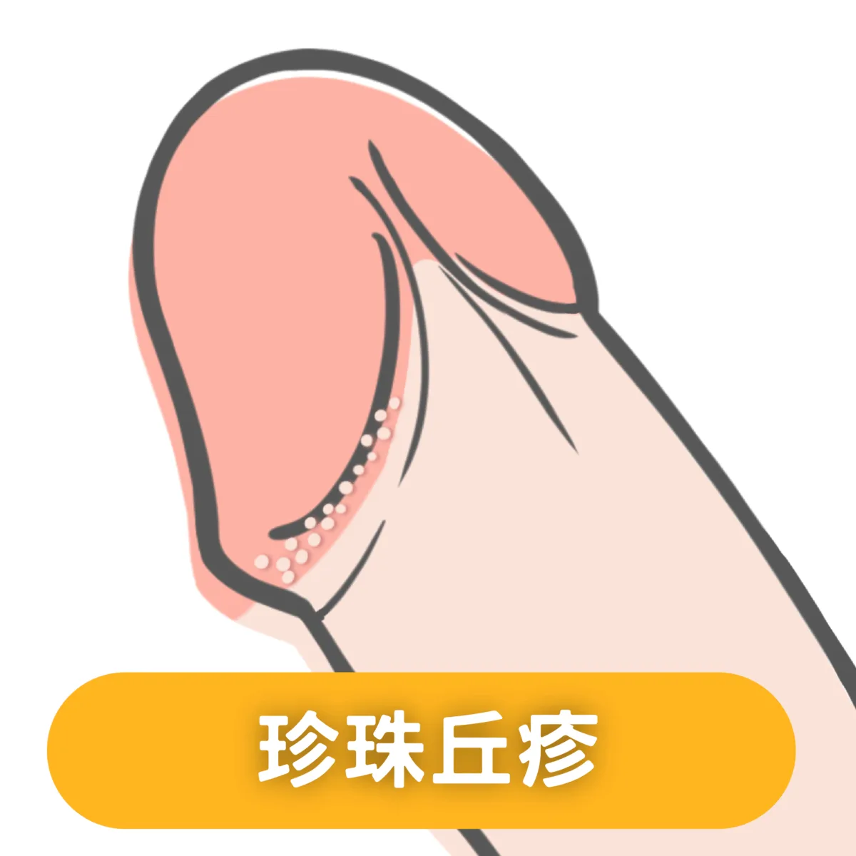 珍珠丘疹