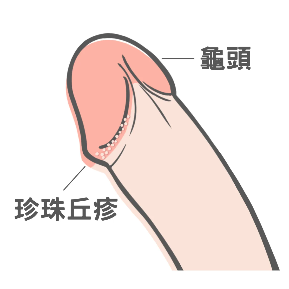 珍珠丘疹